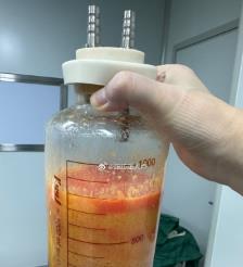京山水动力吸脂手术要做多久？